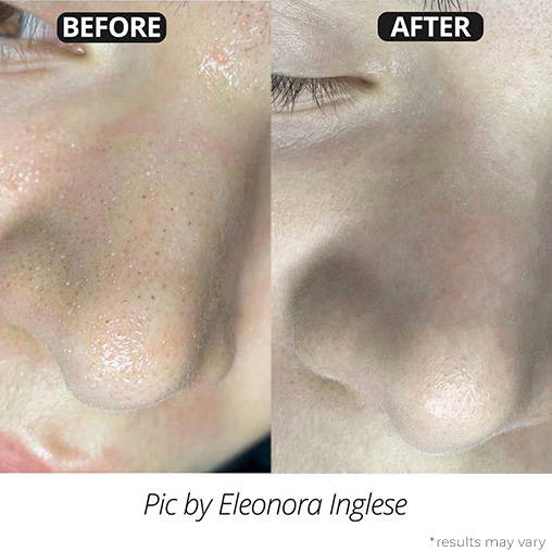 Luxury Confidence Blackhead Remover Aphrodite Blackheads Treatment Kit 2.0 White